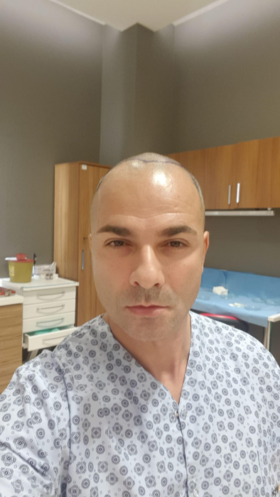 Ești interesat de procedura de implant de păr? Consilierul medical Ensar Duman îți spune ce tehnici noi se realizează în Turcia