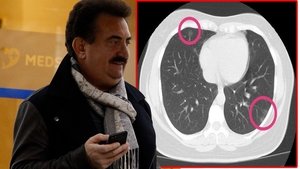 Adevărul despre moartea lui Petrică Mâțu Stoian. Ce au descoperit medicii pe unul dintre plămânii artistului