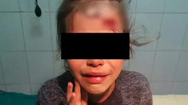 O fetiță din Călărași a ajuns la spital cu capul spart, după ce patroana unui magazin ar fi lovit-o cu un borcan de bulion