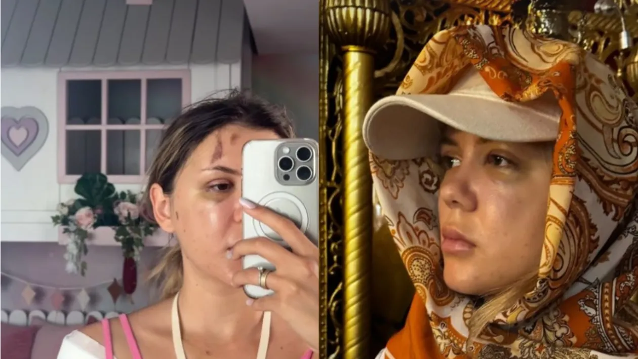 Prima imagine cu Emily Burghelea după ce a ieșit din operație. Fanii s-au cutremurat când au văzut-o