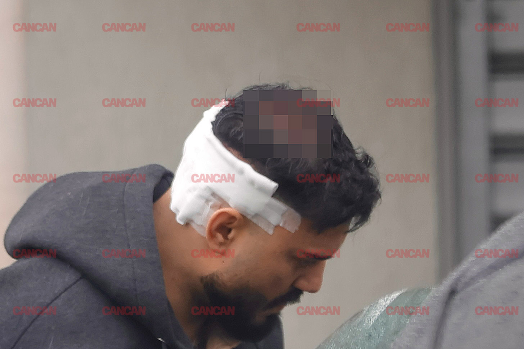 Artistul a mers la o clinică pentru a-și pune implant de păr