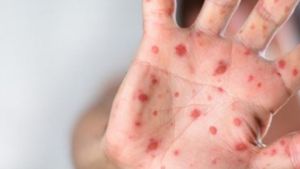 Anunț îngrijorător de la OMS! Un alt virus mortal face ravagii în întreaga lume