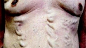 BOALA misterioasa de care sufera acest barbat. Cum a ajuns sa arate asa! Medicii nu au nicio explicatie