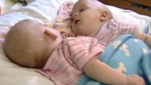 Acum 10 ani, doctorii au încercat să separe cele două siameze! Cum arată fetiţele acum 