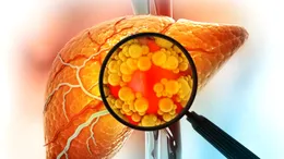 Alimentul care face rău ficatului şi pe care îl consumi zi de zi. TOP 20 de alimente toxice pentru ficat