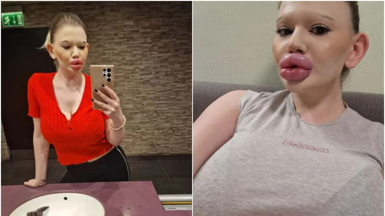 Ireal! Cum a ajuns să arate o tânără de 25 de ani, după ce și-a făcut 30 de intervenții la buze! Nu vrea să se oprească aici