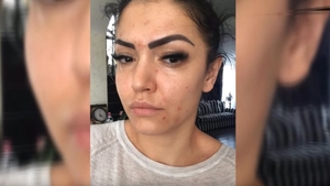 Andreea Mantea, imagini șocante. Vedetei Kanal D i-au ieșit bube pe față