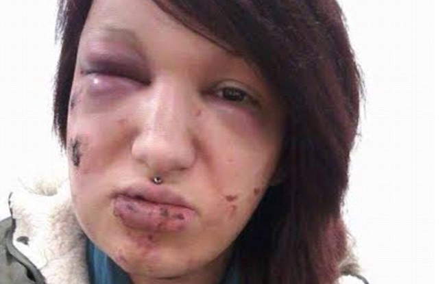 O femeie de 25 ani, traumatizată pe viaţă după fostul ei iubit a muşcat-o pe faţă de 21 de ori! „A încercat să mă mănânce”