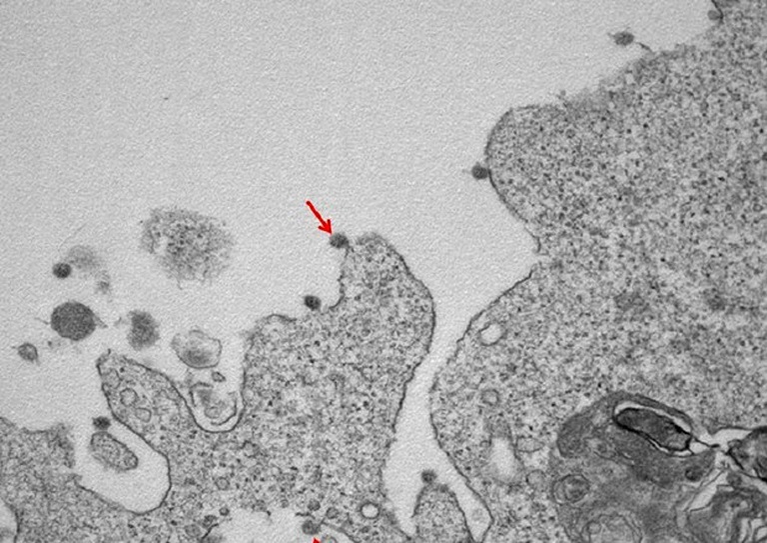 epa08339346 An undated handout picture made available by the Clinical Pathology Lab of the Department of Biomedical Sciences for Health (SCIBIS) at the University of Milan shows an arrow pointing to a novel coronavirus particle attached to cell membranes, displaying its typical glycoprotein spike 'corona' on the viral surface (issued 02 April 2020), seen in an electron microscope image, the first black and white portrait of the SARS-CoV2 virus, which causes the COVID-19 disease, isolated in the northern Italian region of Lombardy at the Sacco Hospital in Milan.  EPA/UNIVERSITY OF MILAN/SCIBIS HANDOUT  HANDOUT EDITORIAL USE ONLY/NO SALES