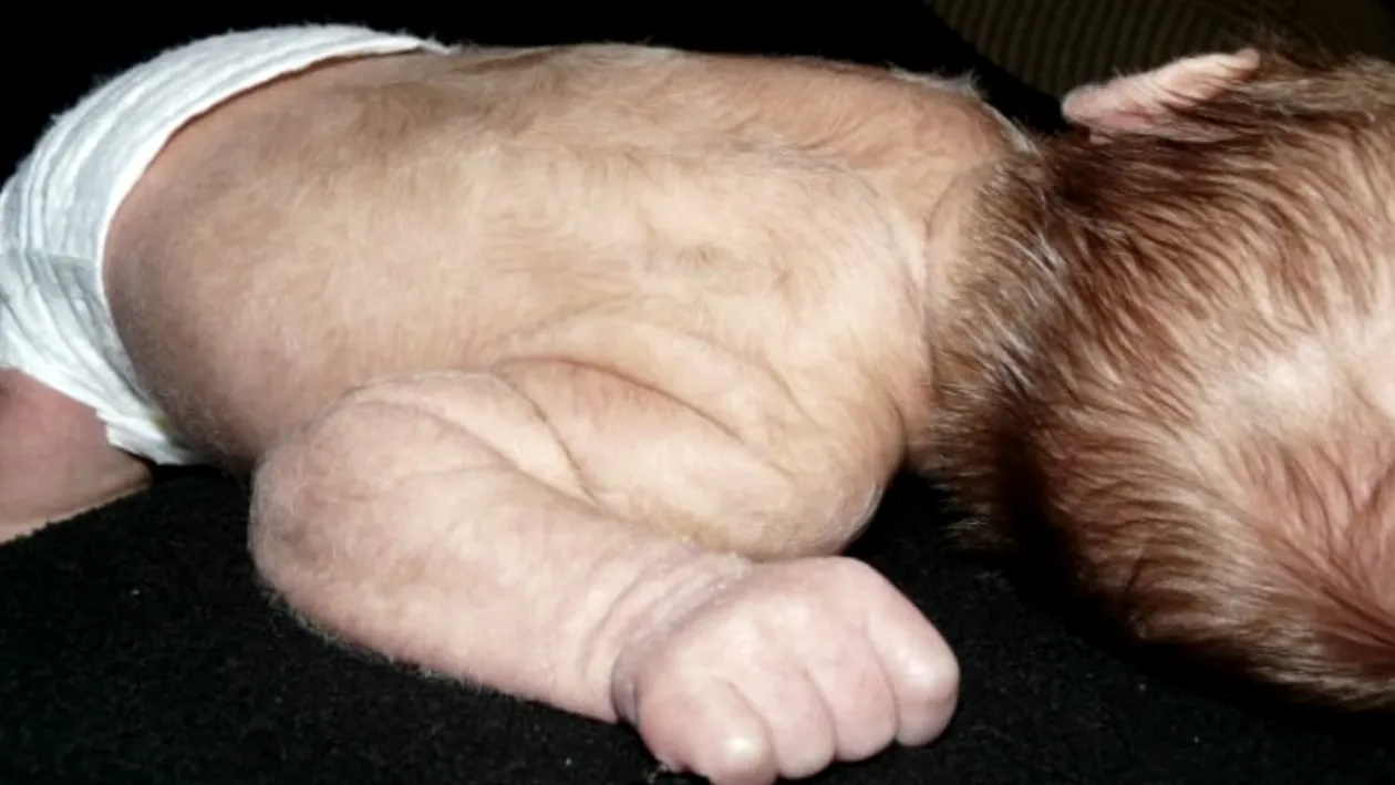 Cum arată băiețelul care s-a născut cu ”sindromul vârcolacului”. Anomalia este una la un miliard