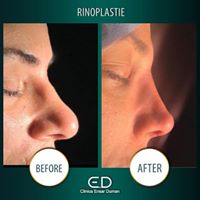 Operația de rinoplastie în Turcia! De ce să alegi pachetele de turism medical când vrei să te operezi la nas