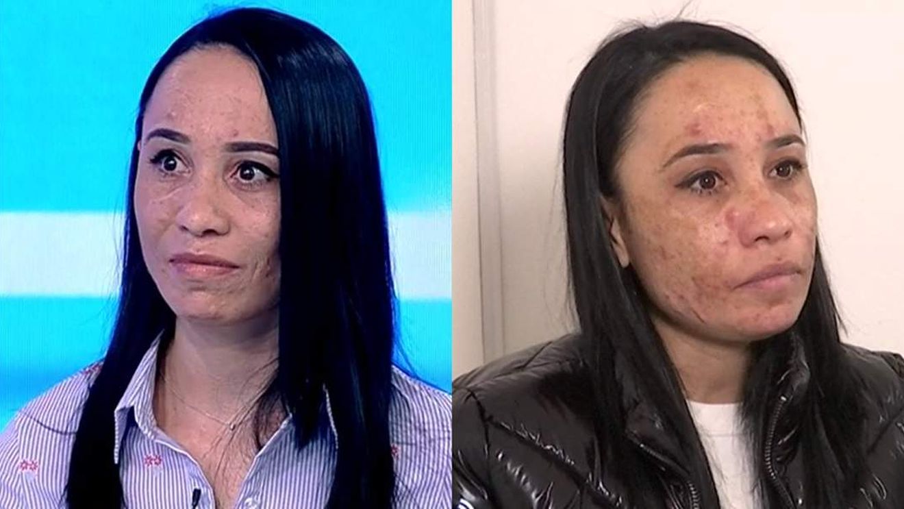 Fața i-a fost distrusă! O tânără a fost desfigurată de un cosmetician. „M-a nenorocit și aș vrea să plătească”