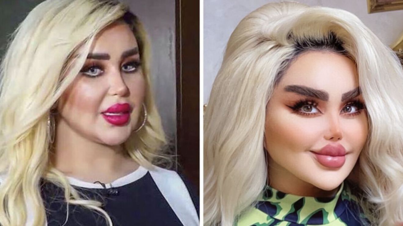 Dalia a vrut să arate ca păpușa Barbie, dar rezultatul i-a șocat pe apropiați. După 43 de operații, tânăra de 30 de ani este asemănată cu un zombi