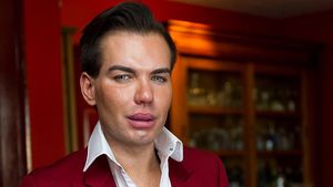 „Păpuşa umană“ KEN şi-a făcut o nouă operaţie estetică şi a mărturisit: „Bucăţi mari de piele au început să mi se desprindă de pe faţă“
