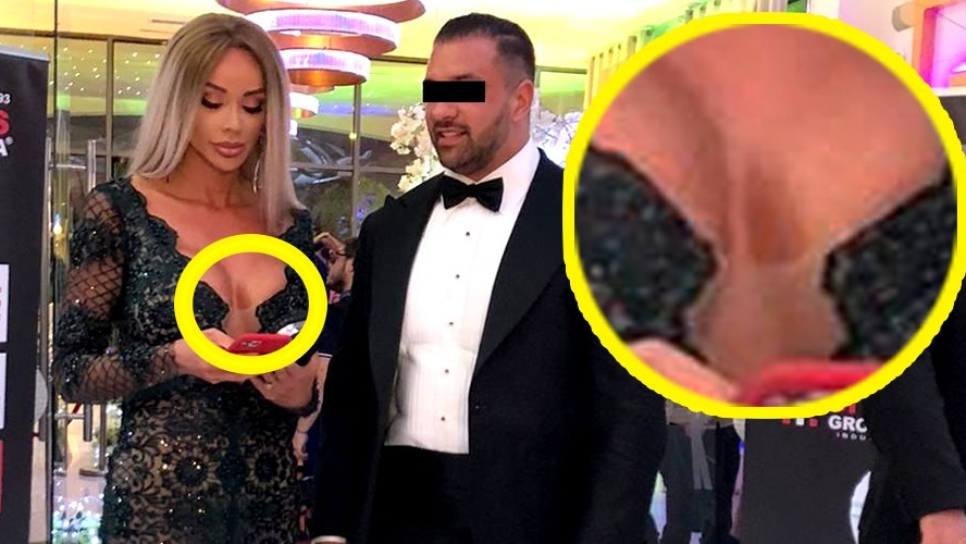 Bianca Drăgușanu, cu o vânătaie imensă pe bust. A fost lovită în sâni?!
