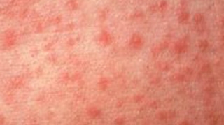 O fetita de 11 ani a murit de rujeola. Alti 5 copii sunt internati cu acelasi diagnostic