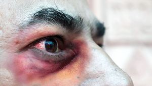 Alertă! „Ciuperca neagră”, care lasă bolnavii de COVID-19 fără ochi, a început să se răspândească în lume