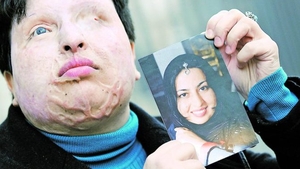 O iranianca desfigurata a primit dreptul sa se razbune! Ii va picura acid in ochi atacatorului