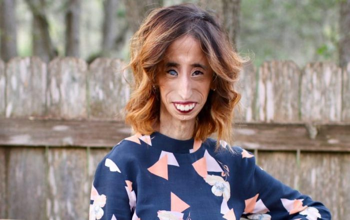 A fost catalogată “cea mai urâtă femeie din lume”, iar acum… Cum arată, în prezent, Lizzie Velasquez