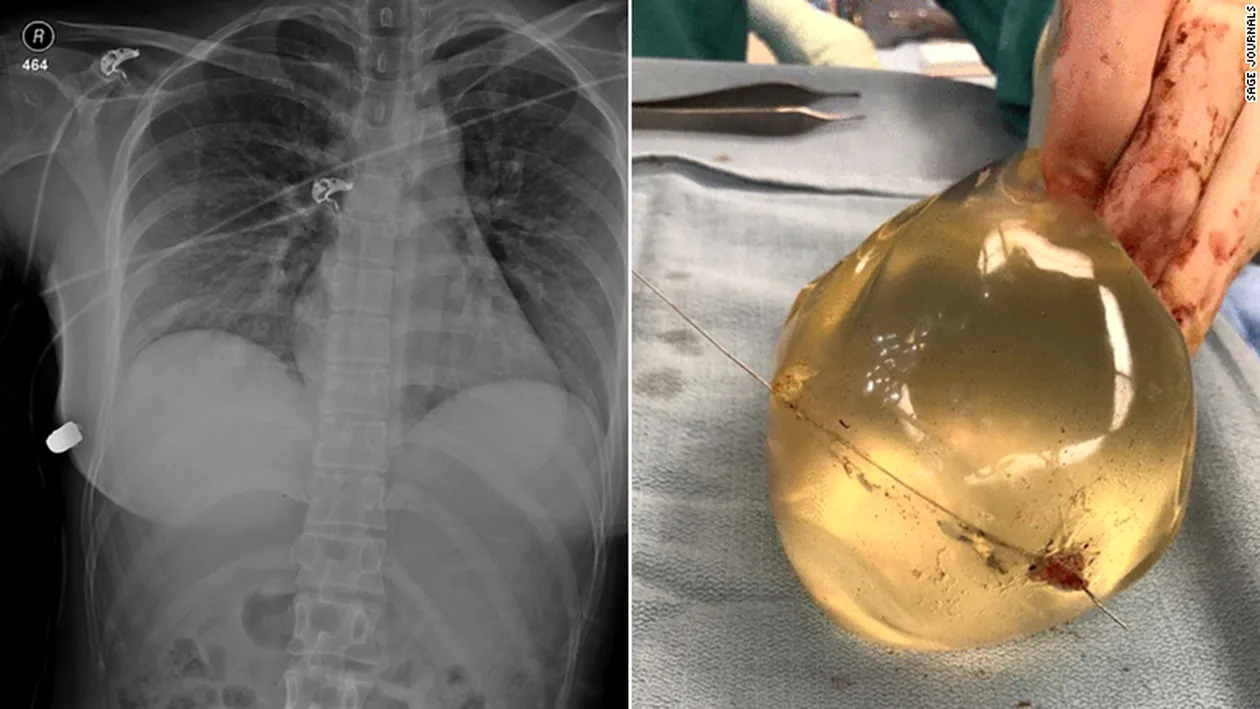 Incredibil! O femeie a supraviețuit unei împușcături, datorită implantului mamar! Glonțul a rămas în silicon FOTO
