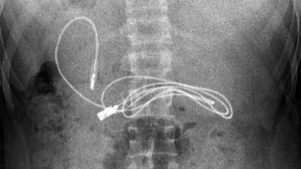 Medicii au crezut că nu văd bine! Ce gadget au putut găsi în stomacul unui adolescent care acuza dureri de burtă