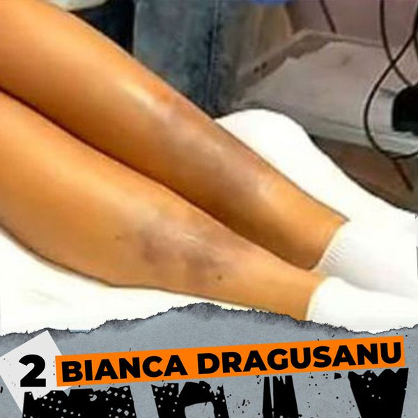 Bianca Drăgușanu nu e singura! TOP 20 – Vedete din România rupte cu bătaia de iubiții lor