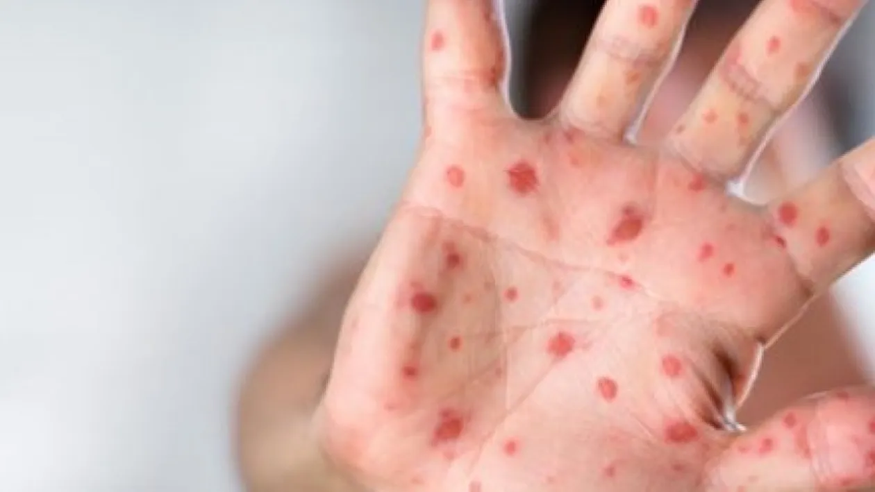 Încă 56 de cazuri de rujeolă au fost confirmate în ultima săptămână în șapte județe