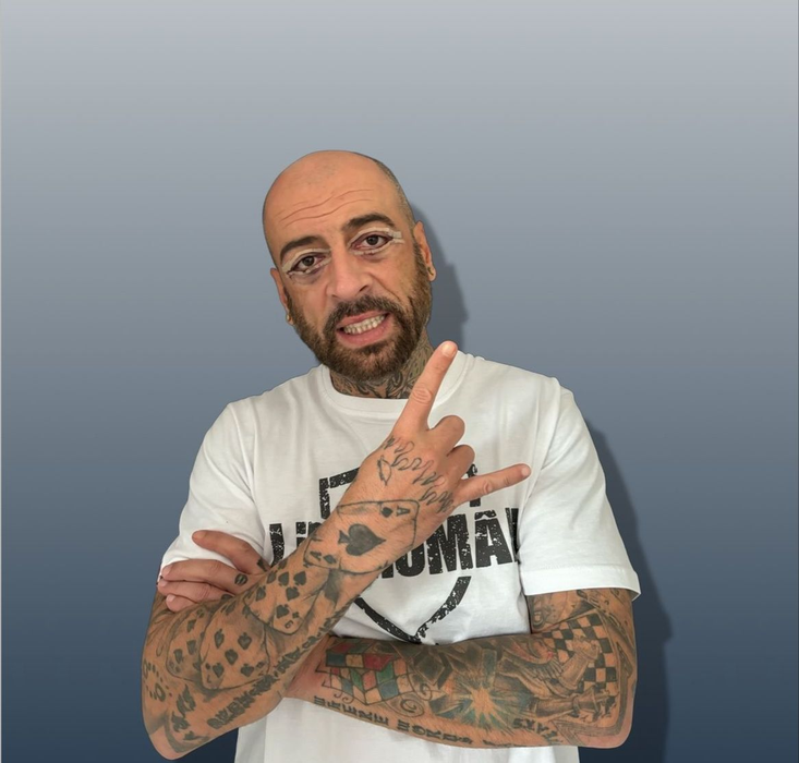 Ochii lui CRBL s-au învinețit după operație. Foto: Instagram / CRBL