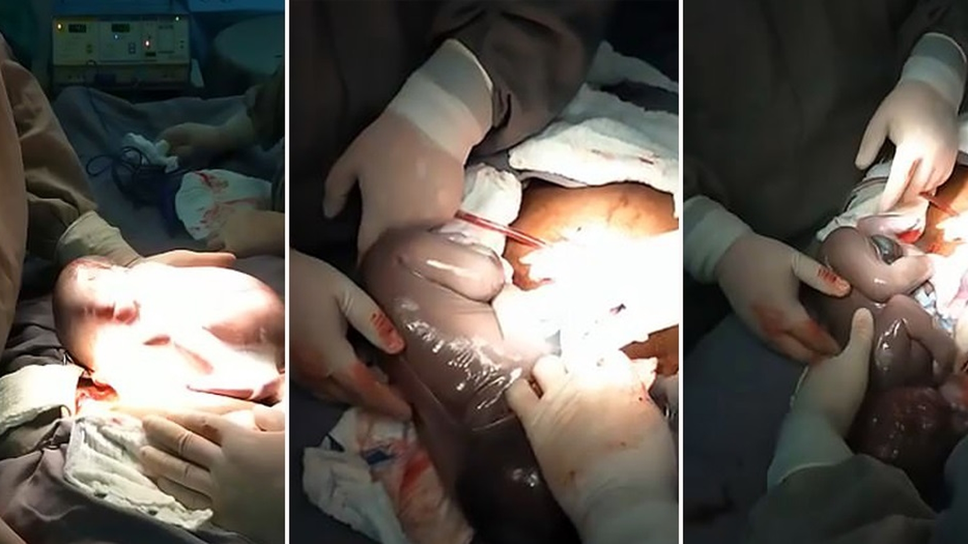 Imagini emoționante în sala de operații: un băiețel s-a născut în timp ce era încă în sacul amniotic. Cazul este foarte rar: 1 la 80.000 de nașteri | FOTO & VIDEO