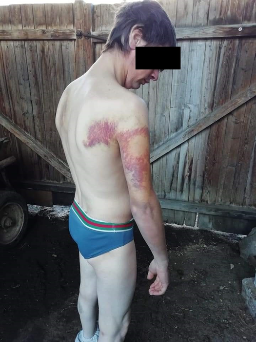 Urmele bătăii pe care tânărul ar fi primit-o la poliție