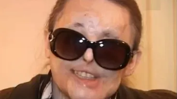 Drama halucinanta a unei romance! La 5 ani dupa ce a fost desfigurata cu acid sulfuric, destinul ii e din ce in ce mai potrivnic