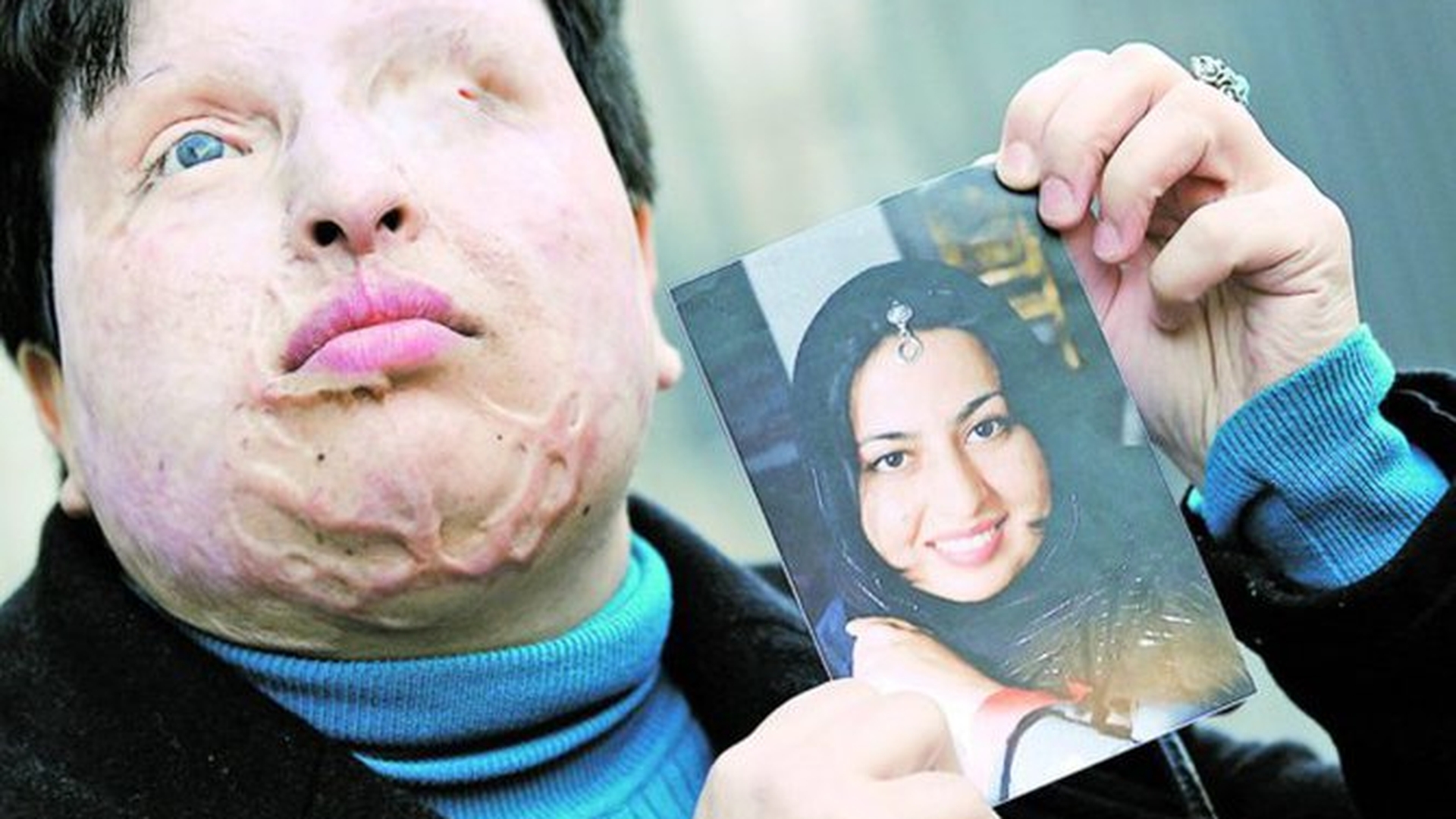 O iranianca desfigurata a primit dreptul sa se razbune! Ii va picura acid in ochi atacatorului