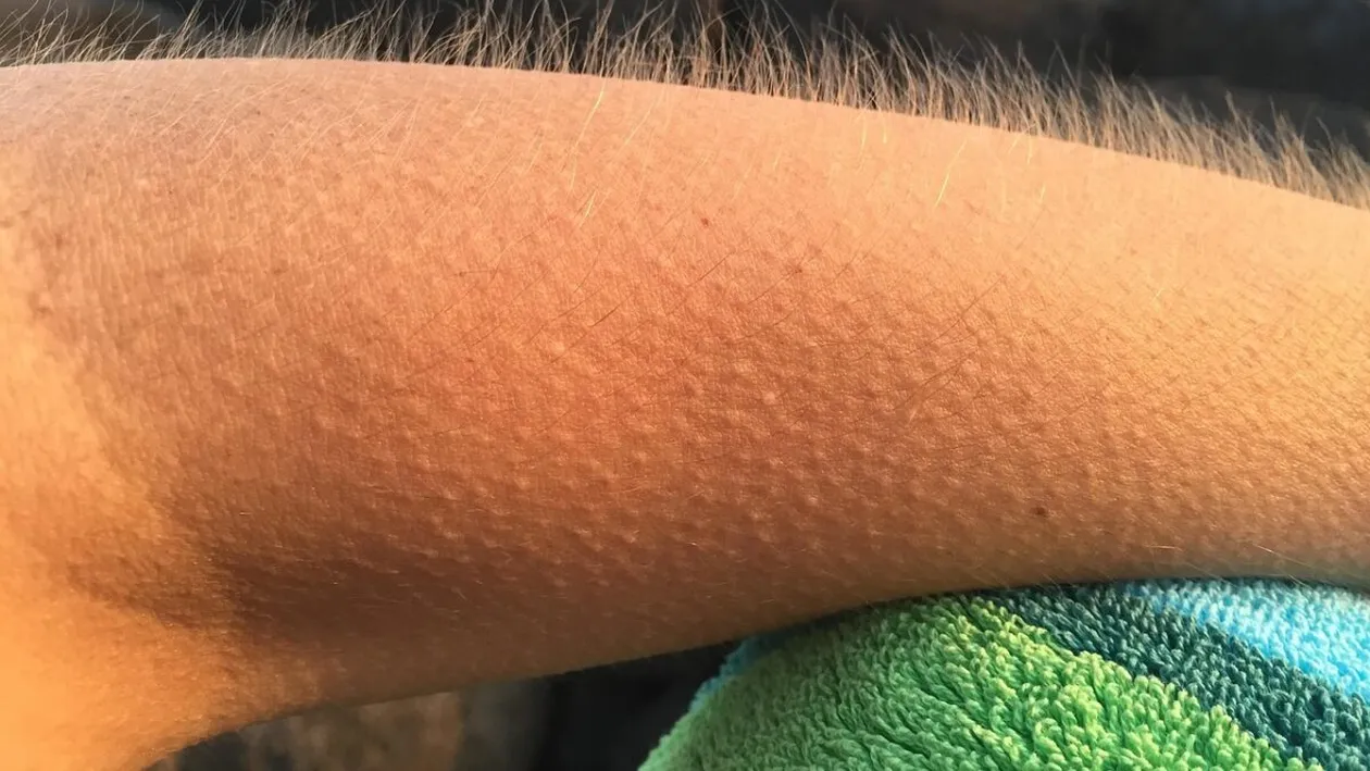 De ce ni se face pielea de găină? Ce este, de fapt, ”fenomenul”