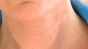 IMAGINI HORROR! Cum a ajuns sa arate o romanca dupa ce a mers la solar. Si-a ars fata si pieptul