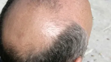 Un actor celebru din Romania si-a facut implant de par: Am fost anesteziat total timp de 7 ore Imaginile pe care vrea sa le uite