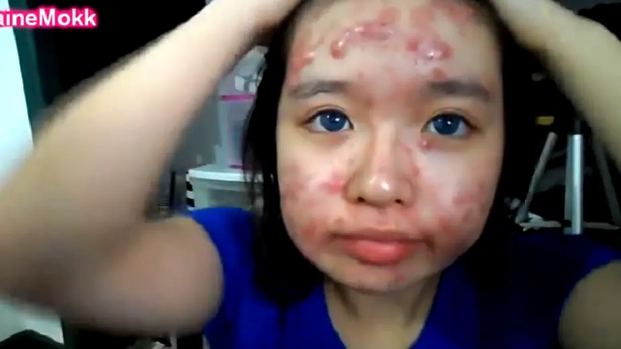 Transformare SOCANTA a unei fete care sufera de acnee! Cum reuseste sa scape de bubele inestetice de pe fata VIDEO