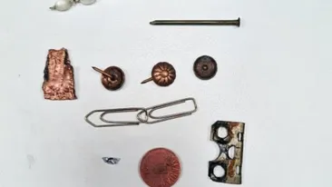 Premieră pentru medicii din Suceava! Au reușit să extragă 8 obiecte ascuțite din stomacul unui bărbat