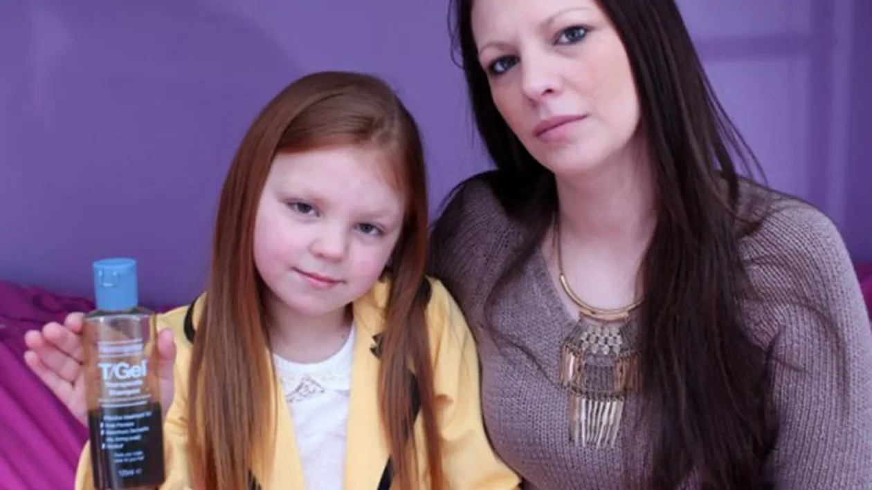 Cum arata fetita care nu s-a spalat niciodata cu sampon! Are sapte ani si sufera de una dintre cele mai rare boli din lume