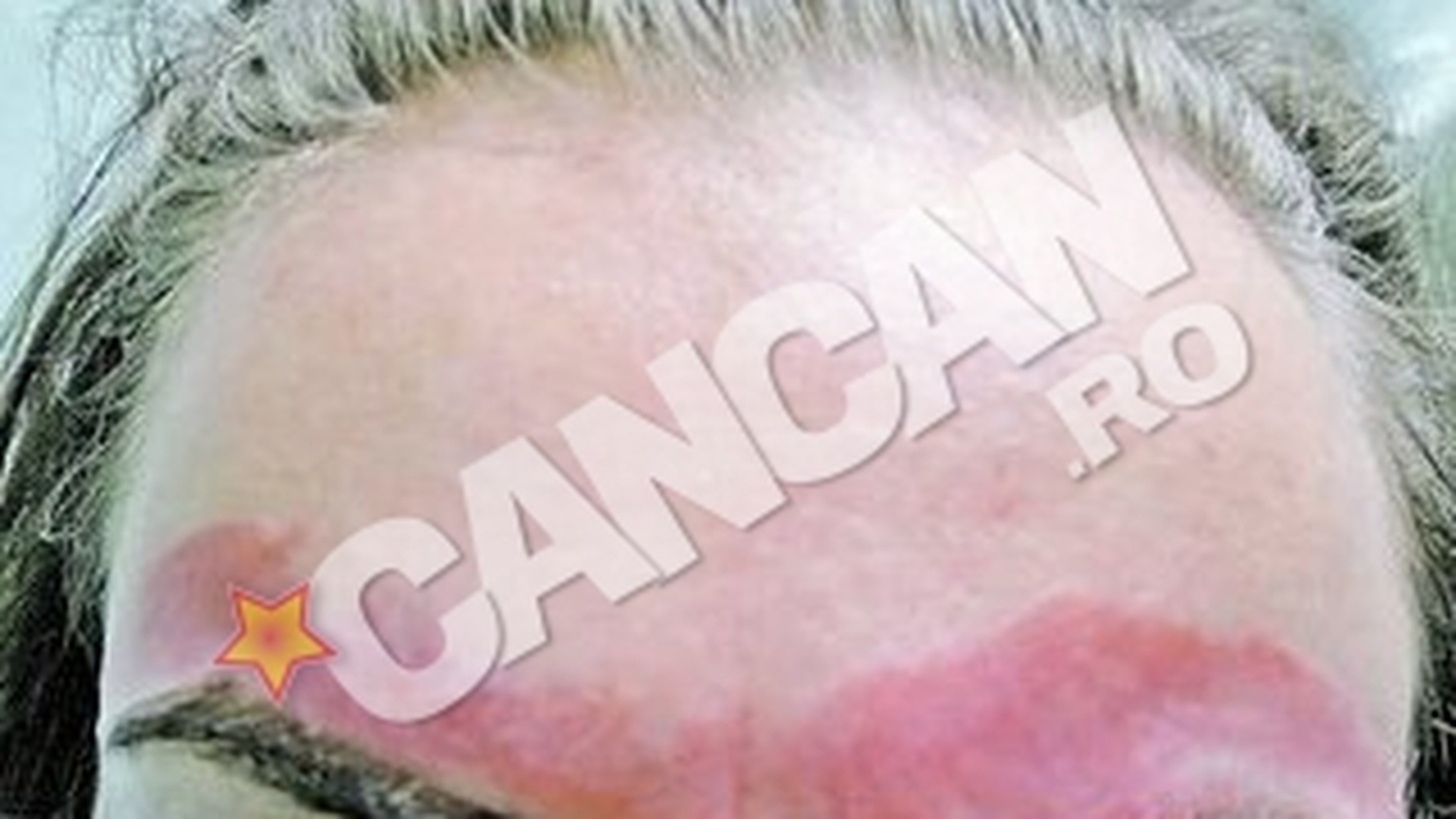 O suceveanca a ajuns la Spitalul de Urgenta din Iasi! Arsa pe fata de ceara de la cosmetica