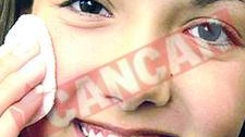 Metode de prevenire a acneei
