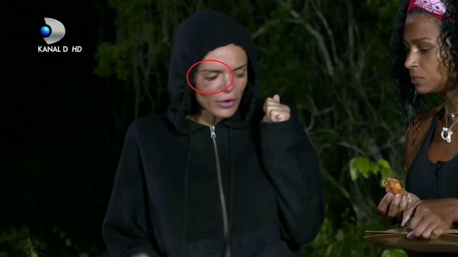 Simona Hapciuc, cu ochiul vânăt