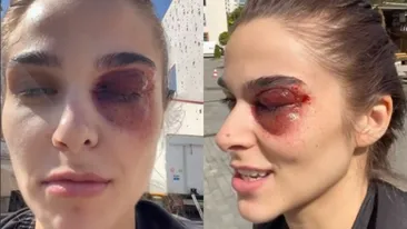 Apariție terifiantă a lui Theo Rose! Artista s-a filmat cu un ochi vânăt: „Cum am ajuns în situația asta?”