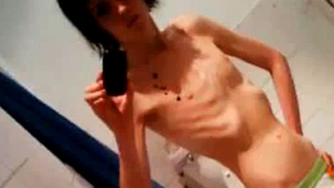 VIDEO Un tanar anorexic din Marea Britanie: "Eram atat de subnutrit, incat propriul meu corp incepuse sa se manance pe interior"