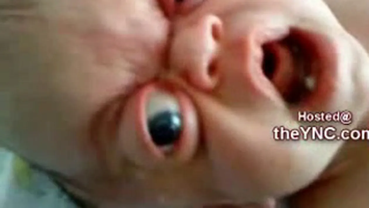 Un video care te va face sa lesini! O anomalie a naturii, copilul cu ochii de broasca si cu capul de capcaun traieste impotriva logicii - Uite ce infiorator arata bebelusul